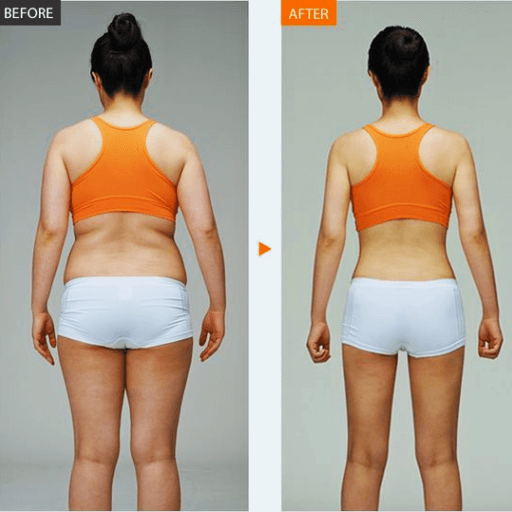 10 vials of sculptra for buttocks before and after pictures