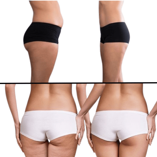 4 vials of sculptra for buttocks before and after pictures