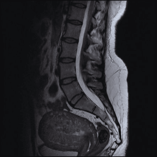 abnormal coccyx mri images