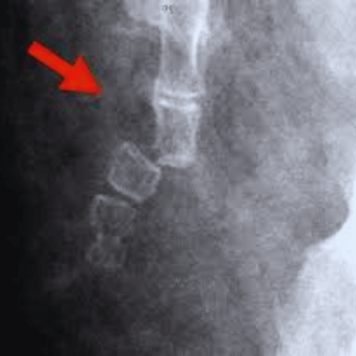 fractured coccyx images